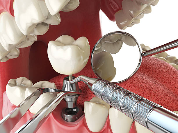 Best Emergency Root Canal Treatment in Jackson, AL